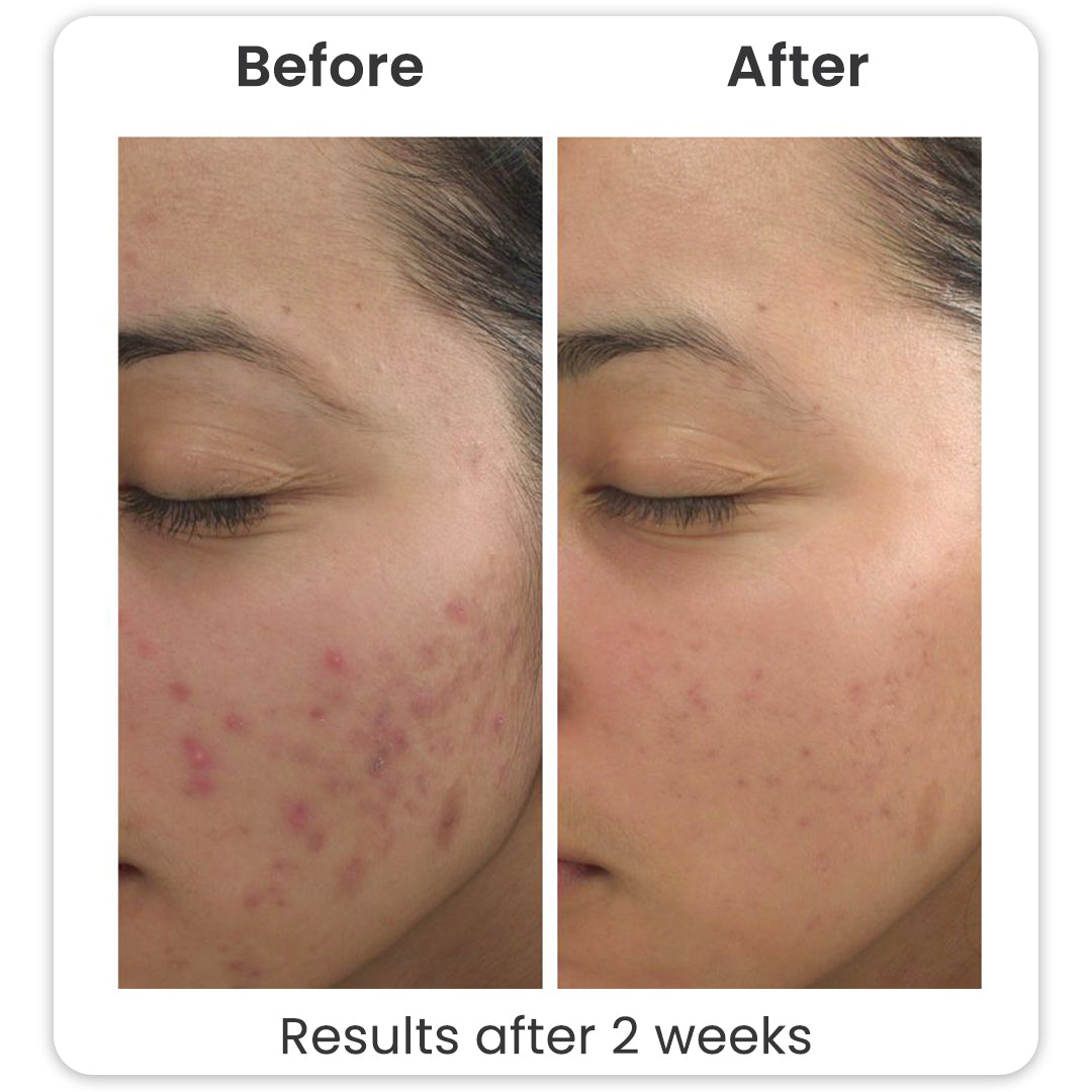 Acne Armor Facewash