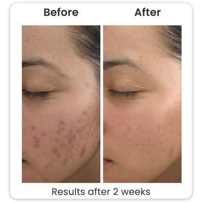 Acne Armor Facewash